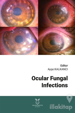 Ocular Fungal Infections